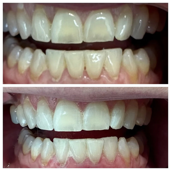 Naturally White whitening result