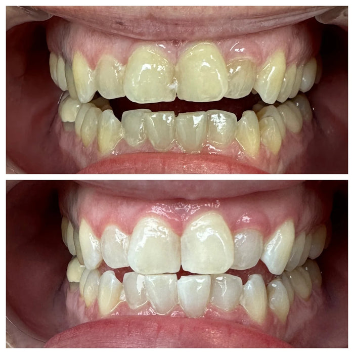 Naturally White whitening result