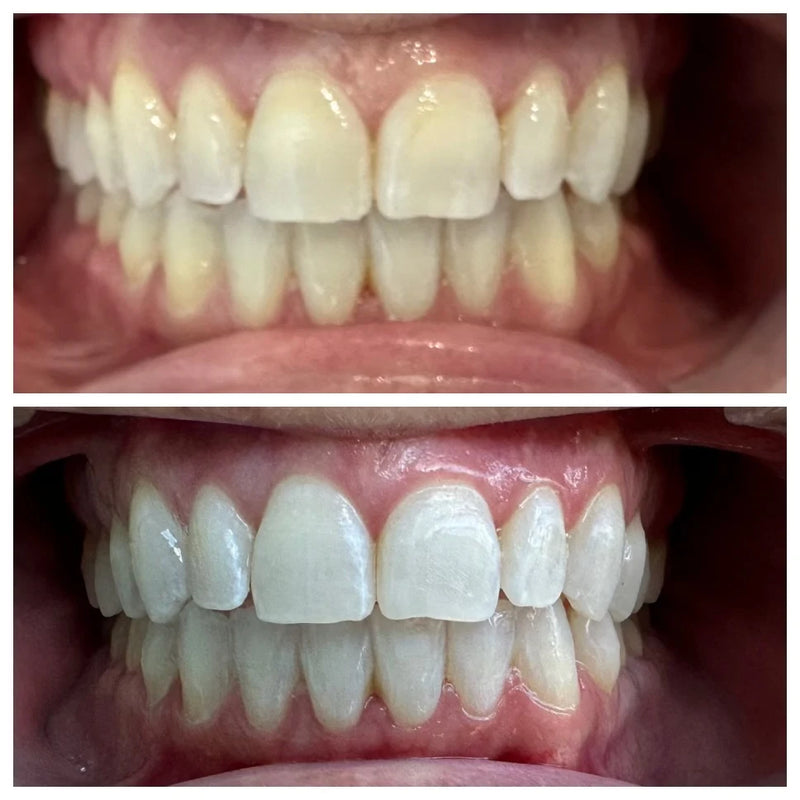Before and after teeth whitening
