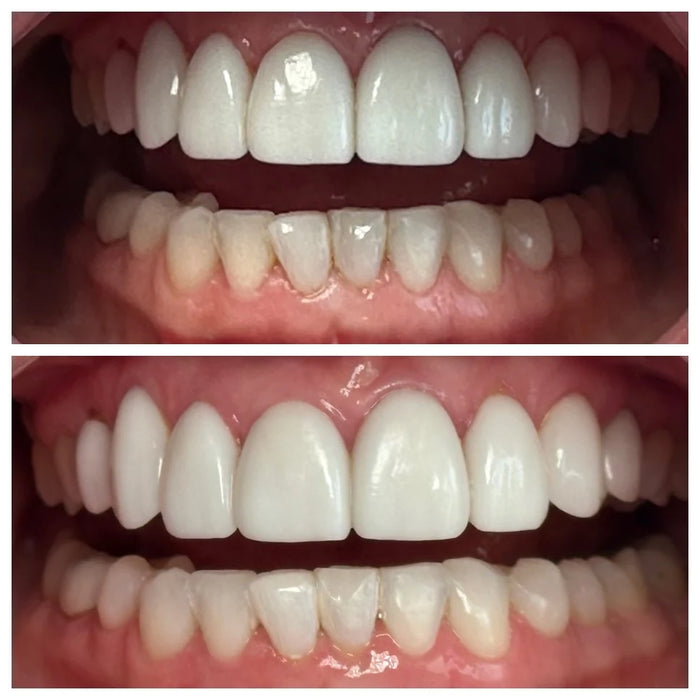 Naturally White whitening result